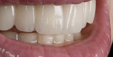 Elite Signature<sup>®</sup>